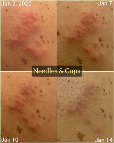 Shingles Progression with Acupuncture Treatment