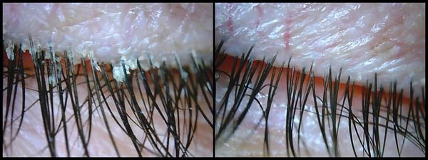 Blepharitis Treatment with BlephEx