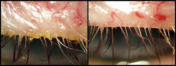 BlephEx Treatment at Eyecare Experts 713-340-0000