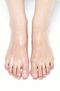 Excessive feet perspiration. Sweaty feet cure. Smelly feet cure.