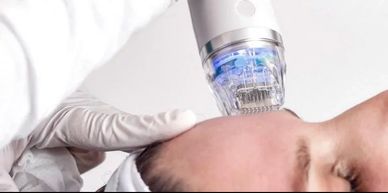 SkinWithin Elite iQ Laser Treatment