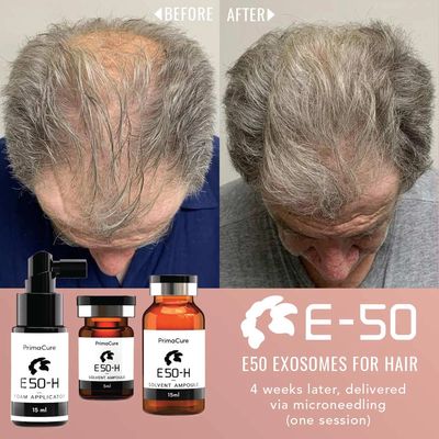 Before and after photo using E-50 Hair Exosome Treatment via microneedling.
