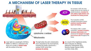 Laser therapy, cold laser therapy, photobiomodulation therapy, class IV laser therapy, pain relief
