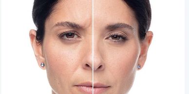 DYSPORT Before and after results.