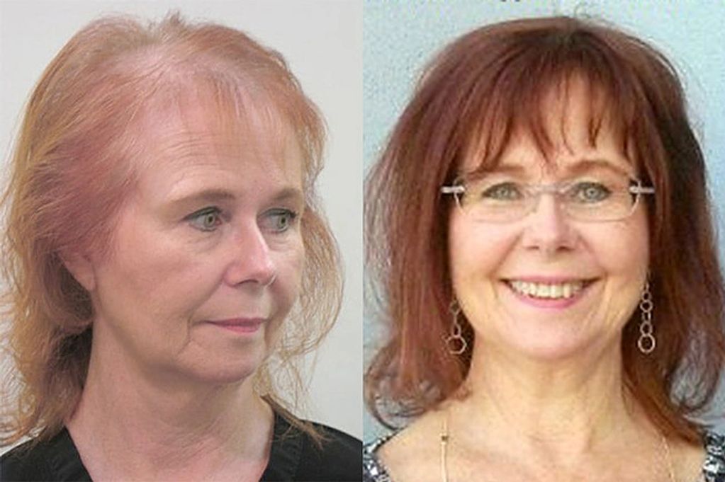 Before and after pictures of nonsurgical hair replacement