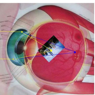 Myopia