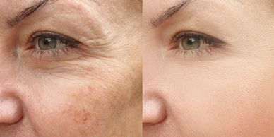 Remove Age Spots