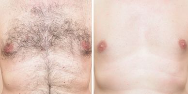 Hair Removal