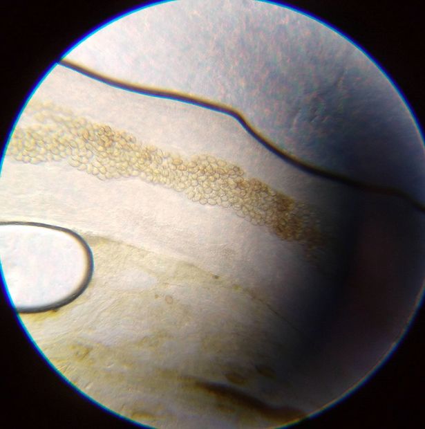 FLUKE infection under microscope