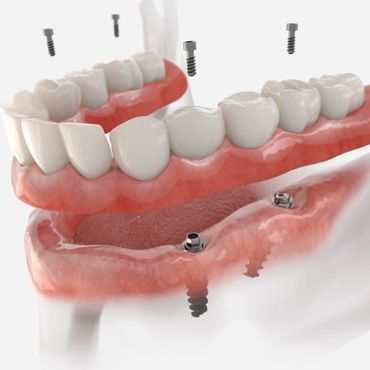 implant üstü protezler