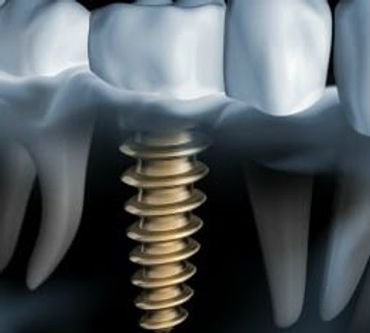 implant tedavileri
