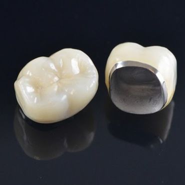 metal destekli porselen