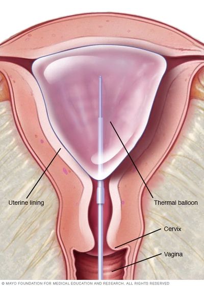 endometrial bleeding, uterine bleeding, ablation, endometrial ablation, pelvic pain, ultrasound
