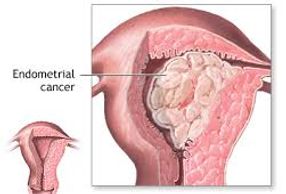 polyps, endometrial polyps, endometrial cancer,uterine bleeding, vaginal bleeding, ultrasound