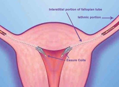 fertility, infertility, essure coils, contraception, endometrial ablation,  ultrasound