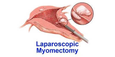 myomectomy, fibroids, hysterectomy, uterine fibroids, ultrasound, pelvic ultrasound, surgery