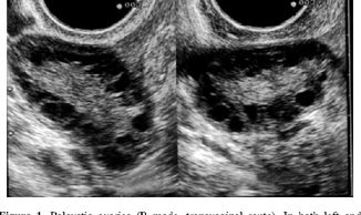 PCOS, polycystic ovaries, London polycystic ovarian syndrome, London PCOS, London,gynecologist