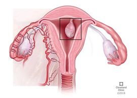 polyps, endometrial polyps, fibroids, adenomyosis, pelvic pain, uterine bleeding, vaginal bleeding