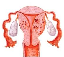 fibroids, uterine fibroids, adenomyosis, pelvic pain, uterine bleeding, vaginal bleeding, ultrasound