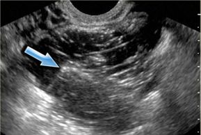 Dermoid, dermoid cyst, ovarian cyst,London women's clinic, pelvic pain, gynecologist
