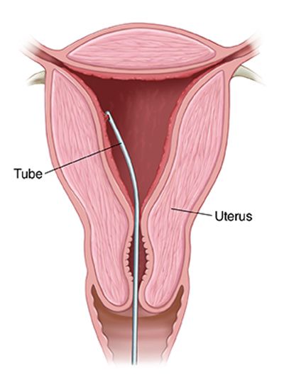 Endometrial Biopsy