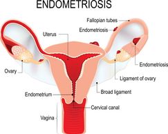 endometriosis, endometrioma, pelvic pain, pelvic ultrasound, ultrasound, gynecologist, infertility
