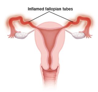 fertility, infertility, fallopian tube, fallopian tubes, salpingitis,  pregnancy, ultrasound