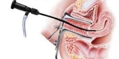 hysteroscopy, vaginal bleeding, uterine bleeding, endometrial biopsy, fibroid, polyp, uterine cavity