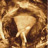 IUD, IUCD, IUDs, fibroids, adenomyosis, pelvic pain, uterine bleeding, vaginal bleeding