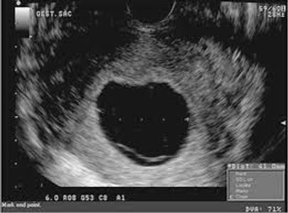 Empty Sac, or aneembryonic pregnancy
