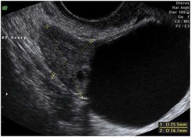 paraovarian cyst, hemorrhagic cyst, ovarian cyst, corpus luteal cyst, pelvic pain, ultrasound