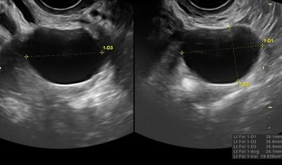 Typical benign ovarian cyst