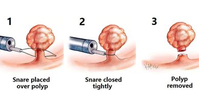 polyp, endometrial polyp, vaginal bleeding, uterine bleeding, endometrial biopsy,  endometrial cance