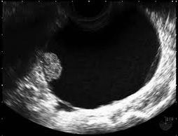 Ovarian cyst, ovarian cancer, London Women's clinic, pelvic pain, gynecologist