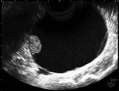 Ovarian Cancer Requiring Sugery