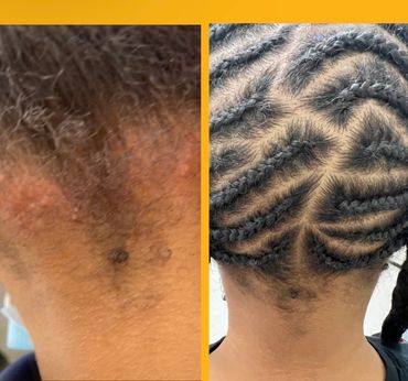 Before and after images showing hair growth and neat braids on the back of a person's head.