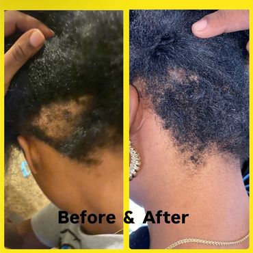 Before and after photos showing hair regrowth and improvement in scalp condition.