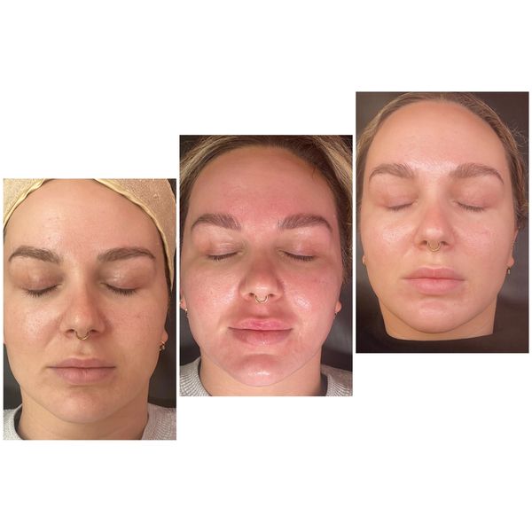 chemical peel results canberra