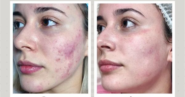 acne skin treatment