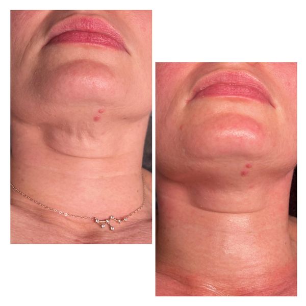 RF Skin tightening results