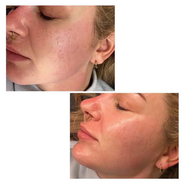 dermaplaning before and after photo