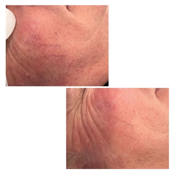 vascular IPL results