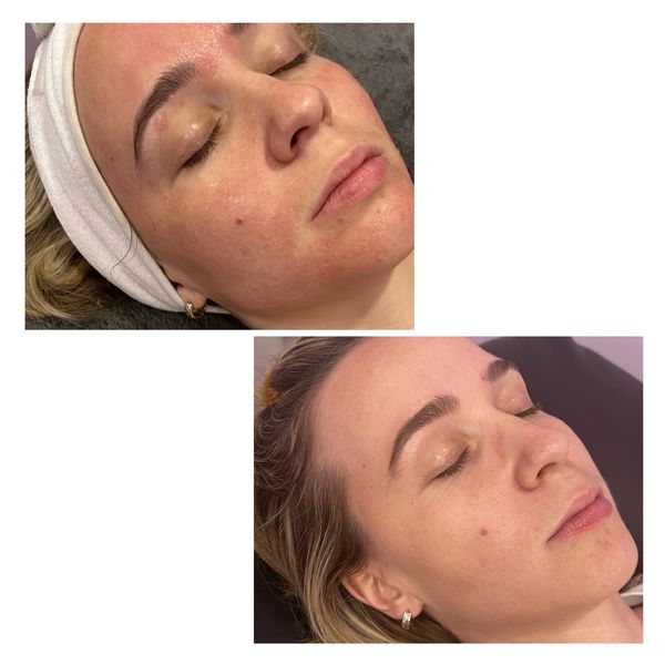 chemical peel results