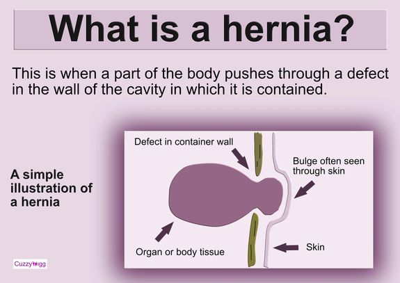 What is a hernia?