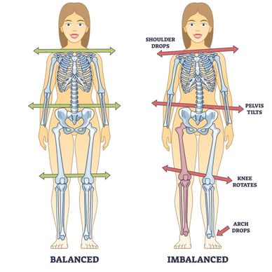 Drawing of skeleton showing impact of leg length discrepancy on body alignment. 