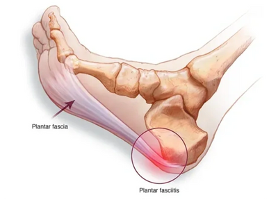 Anatomical image of a foot showing where plantar fasciitis pain is most often found in the heel. 