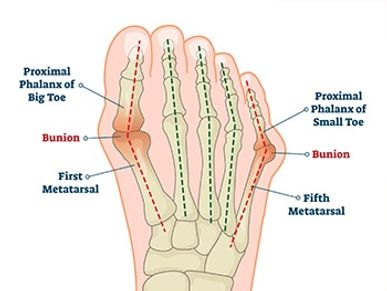 Anatomical image of foot showing where bunions can occur at 1st and 5th metatarsophalangeal joints. 
