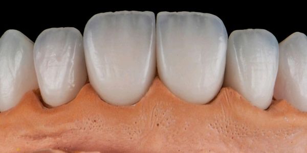 Close-up of dental prosthetic teeth on a gum model.