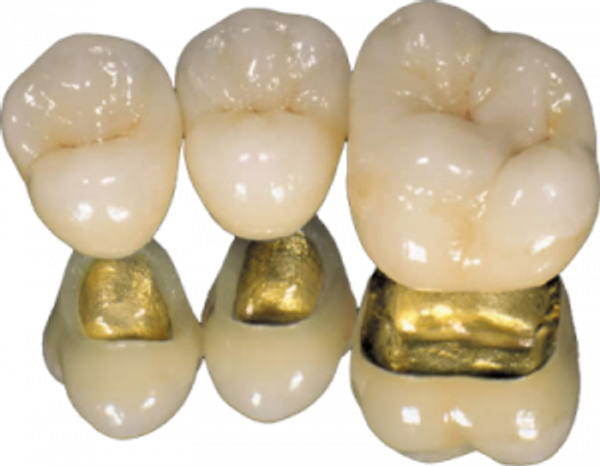 Three dental crowns with gold bases displayed in a row.
