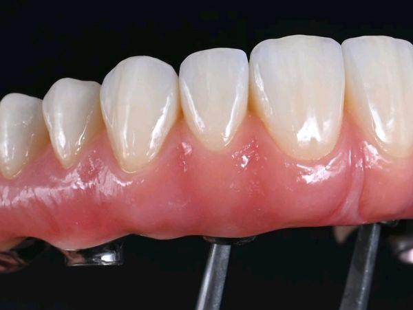 Close-up of a dental prosthetic with artificial teeth and gums.